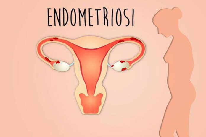 endometriosi