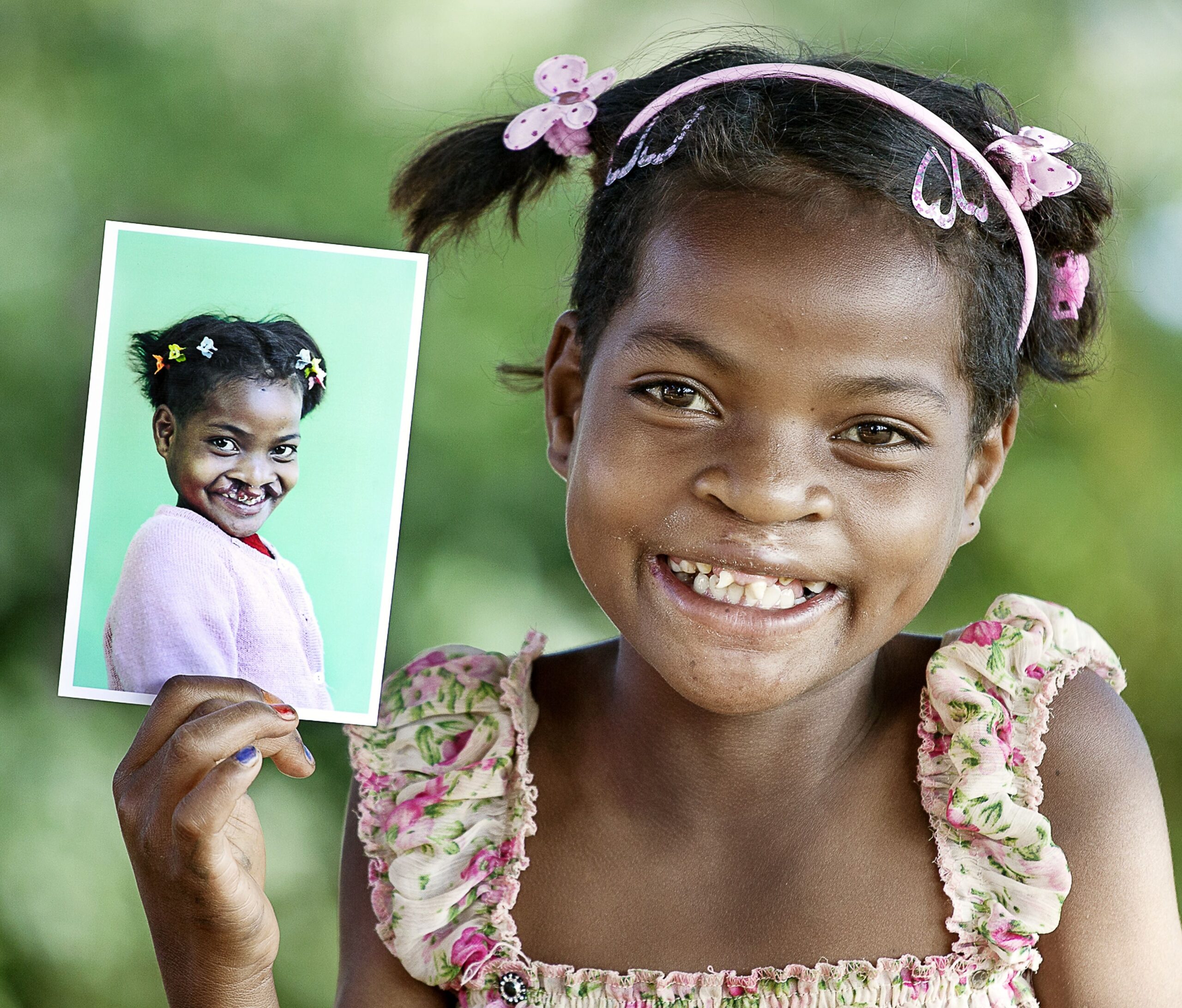 Clara_Madagascar_OperationSmile